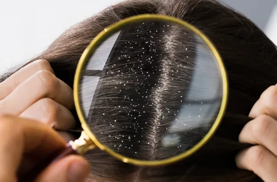 🧴انترفارما | التخلص من قشرة الرأس نهائيًا